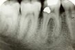 How Root Canal Treatment Saves Teeth